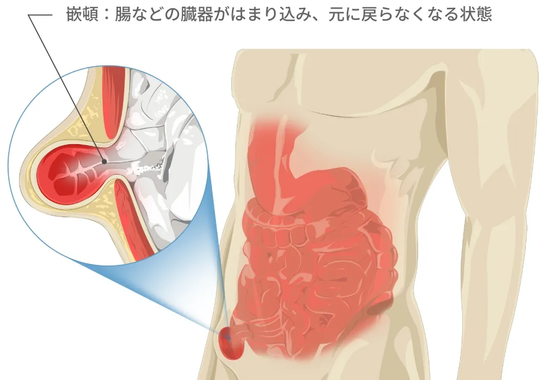 鼠径ヘルニアの嵌頓（かんとん）状態のイラスト