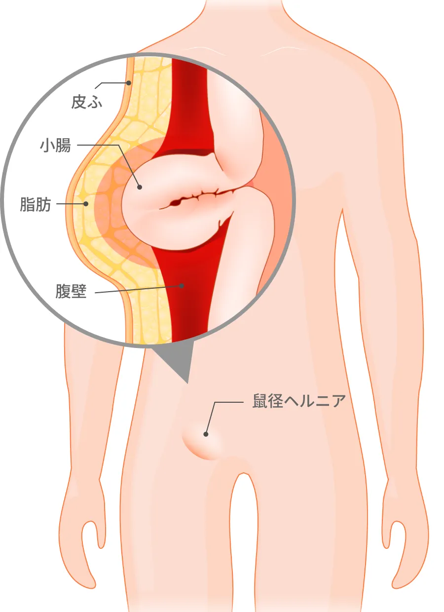 鼠径ヘルニアのお悩み